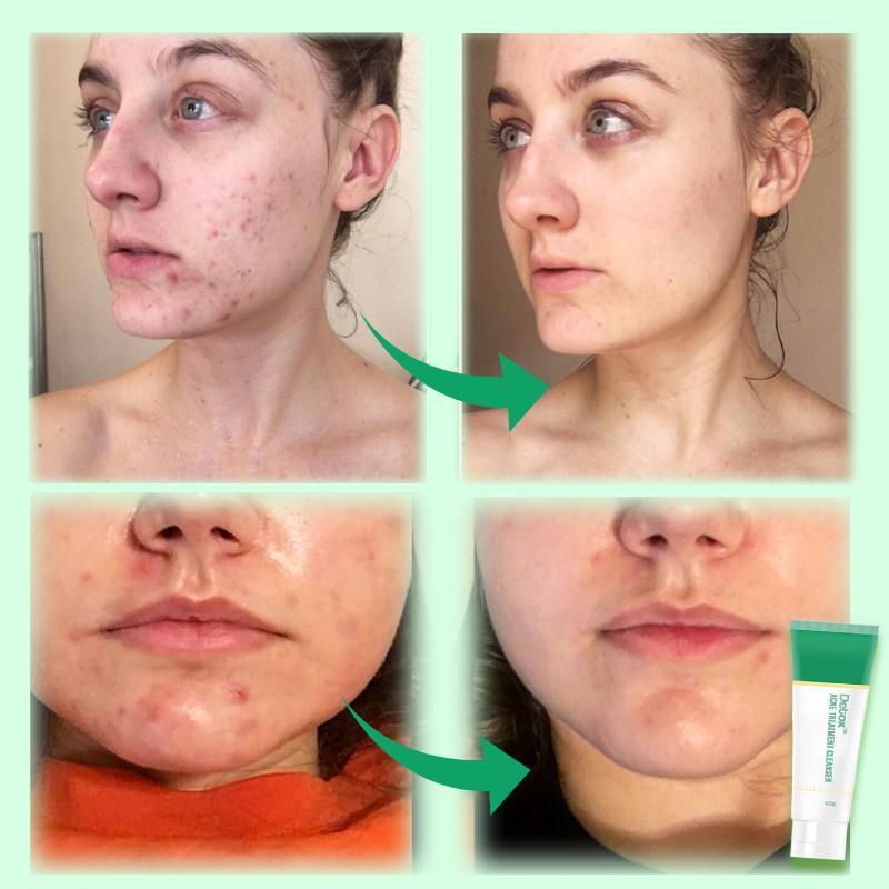 Nettoyant détox pour le traitement de l'acné – Image 2